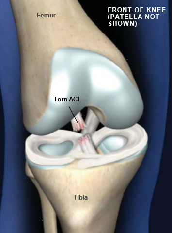 Anterior Cruciate Ligament (ACL) - Village Physiotherapy Shellharbour