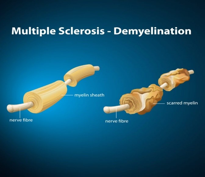 Multiple Sclerosis